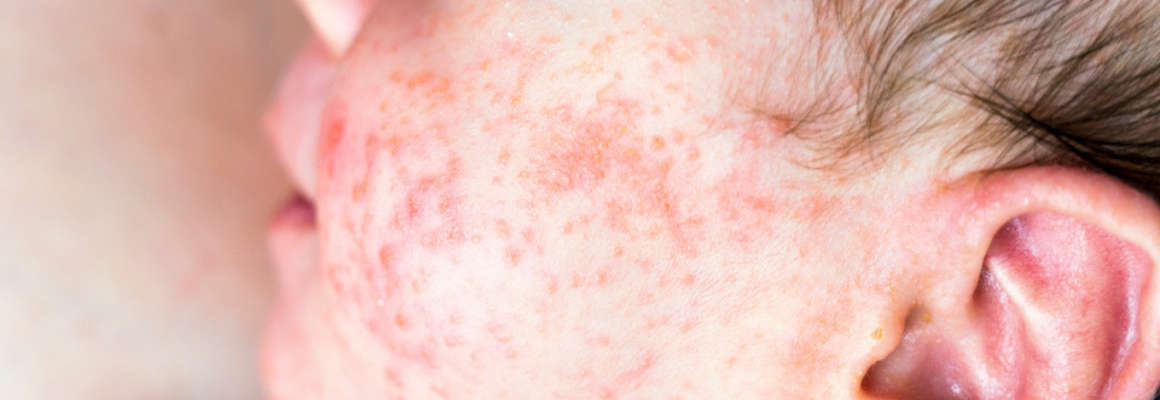 close up shot of rash on cheek