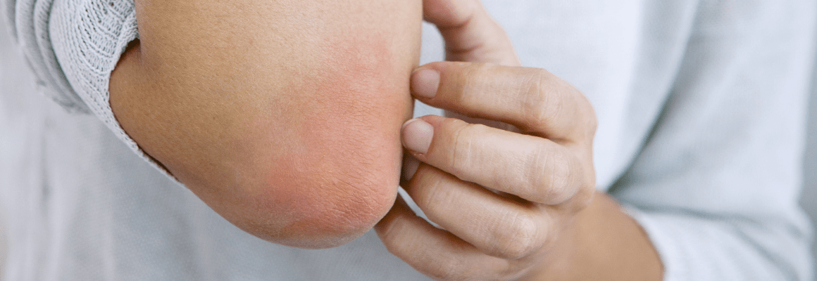 person scratching red rash on elbow