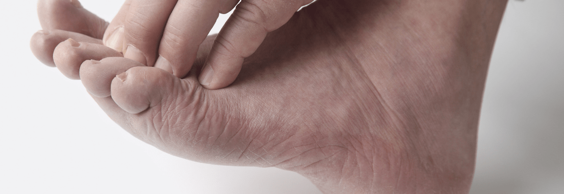 person scratching eczema between toes