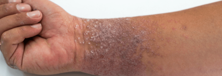 man with eczema on wrist