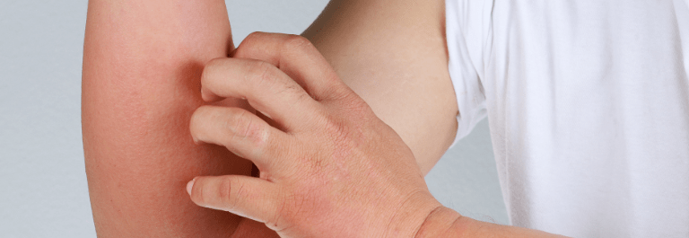 person scratching itchy arm