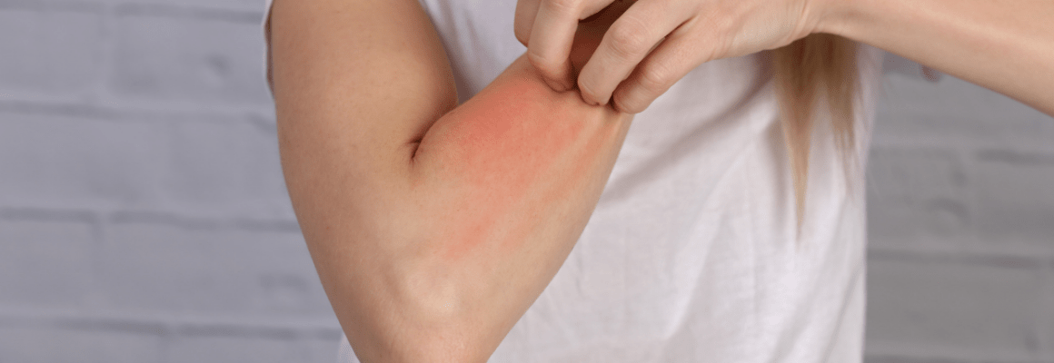 person in white shirt scratching red rash on arm