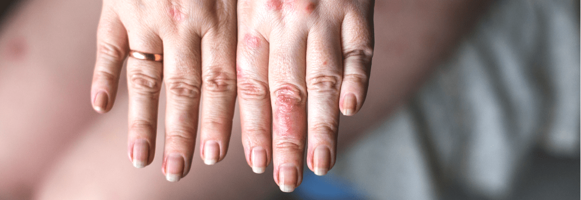 close up of womans fingers, one with a gold ring