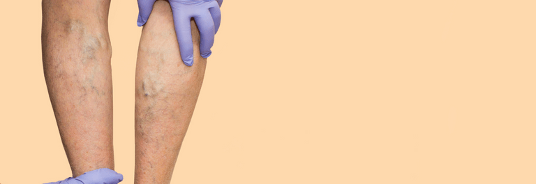 scratching leg - varicose eczema