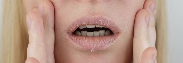 woman with dried lips - lip lickers dermatitis