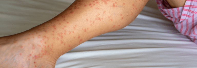 papular eczema on a person's leg