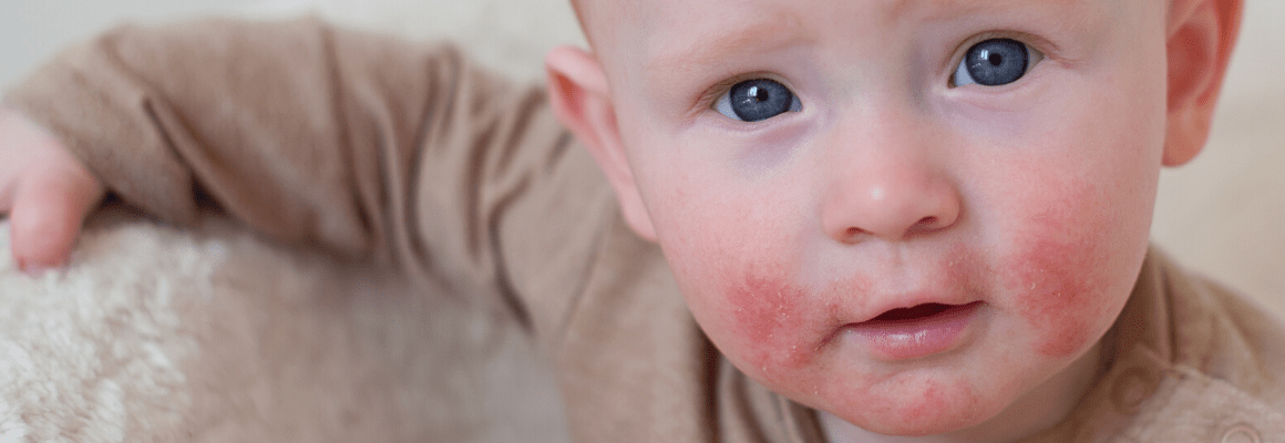 little baby boy with red rash on cheeks