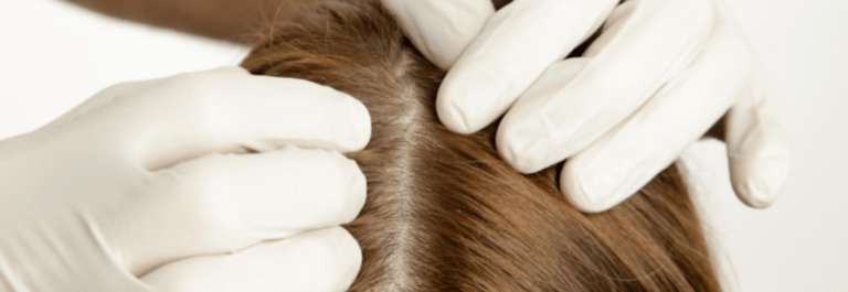 person with white gloves inspecting scalp eczema