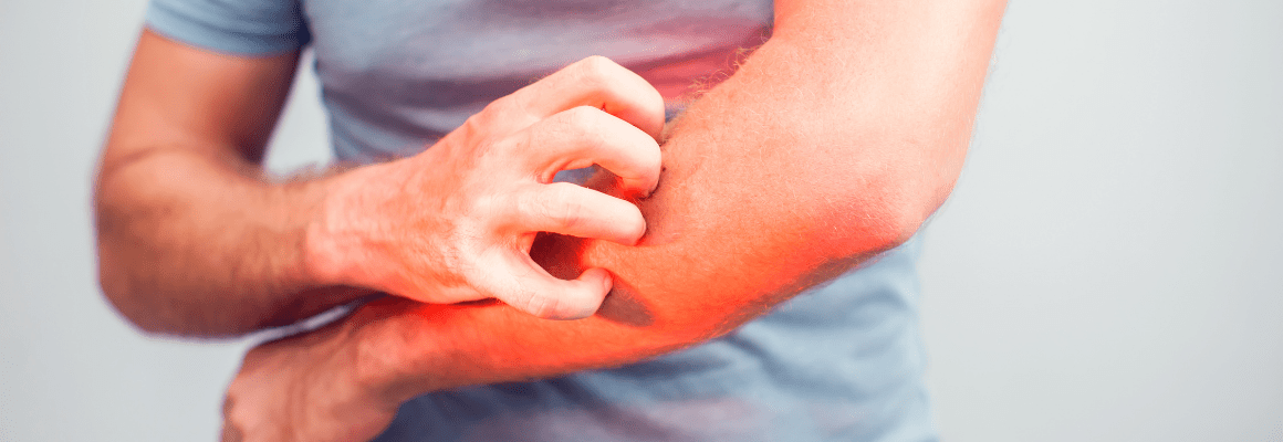 man scratching red and irritated arm
