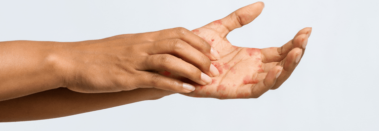 person scratching palm - stress related eczema on hands