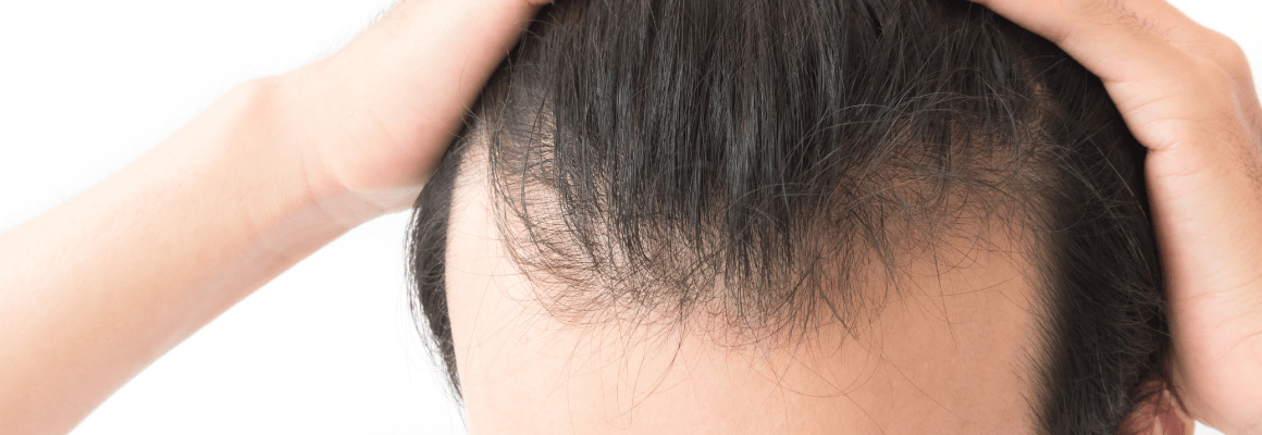 balding man pulling hair back on scalp