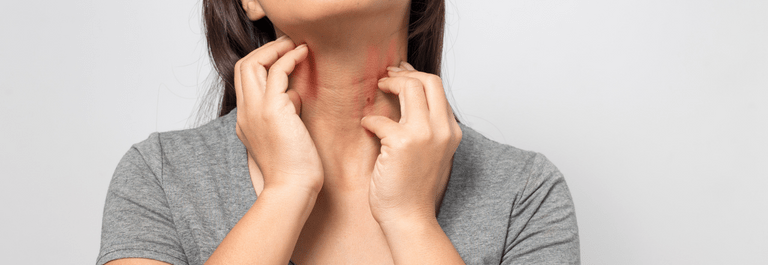 woman scratching neck - treating sudden eczema