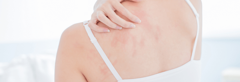 woman scratching shoulder - will eczema go away