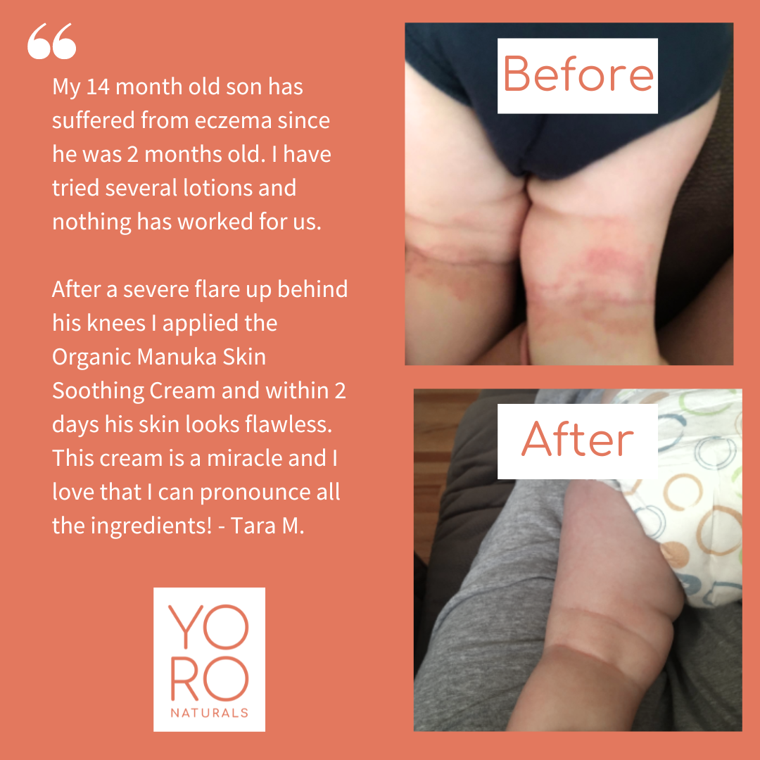 Organic Manuka Skin Soothing Cream by YoRo Naturals