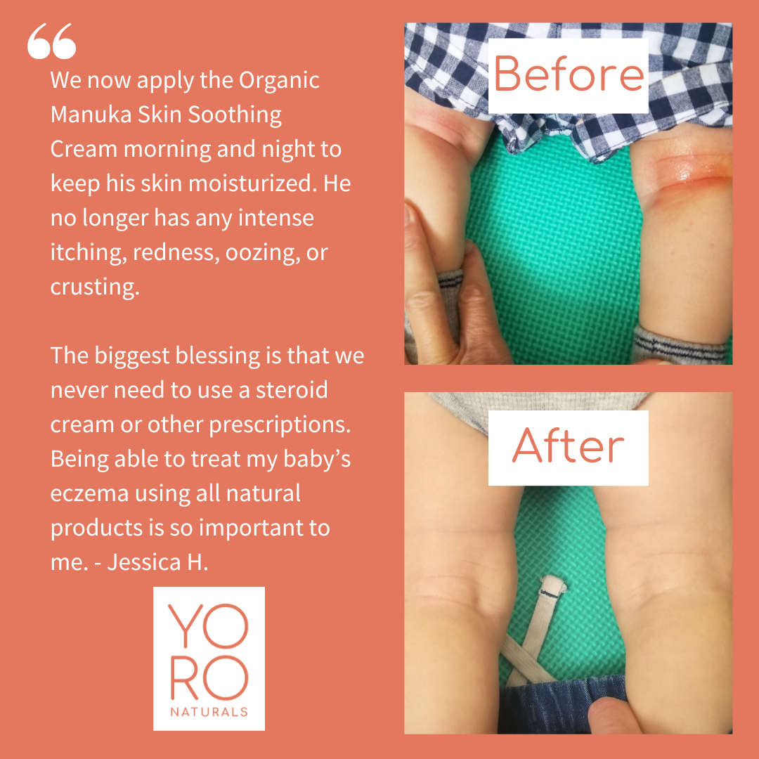 Organic Manuka Skin Soothing Cream by YoRo Naturals
