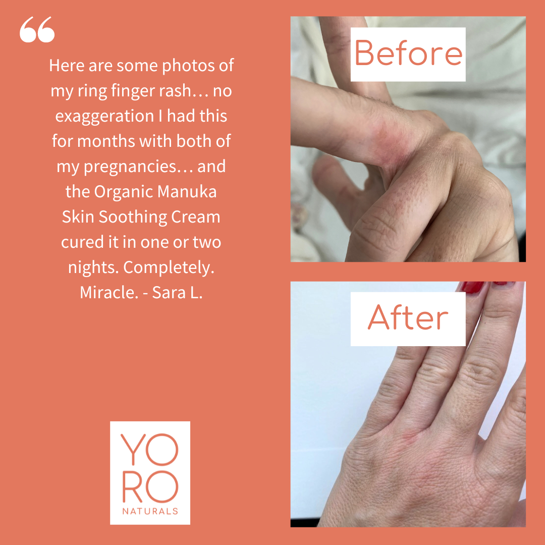 Organic Manuka Skin Soothing Cream by YoRo Naturals