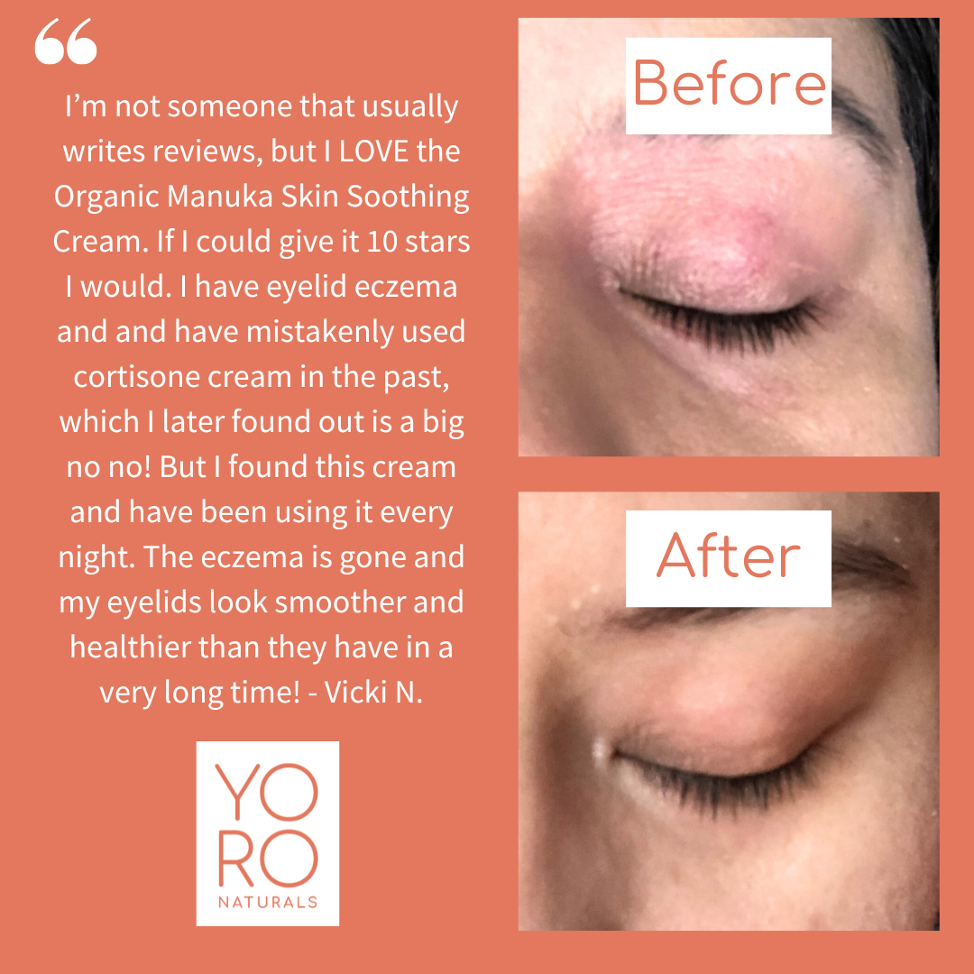 Organic Manuka Skin Soothing Cream by YoRo Naturals
