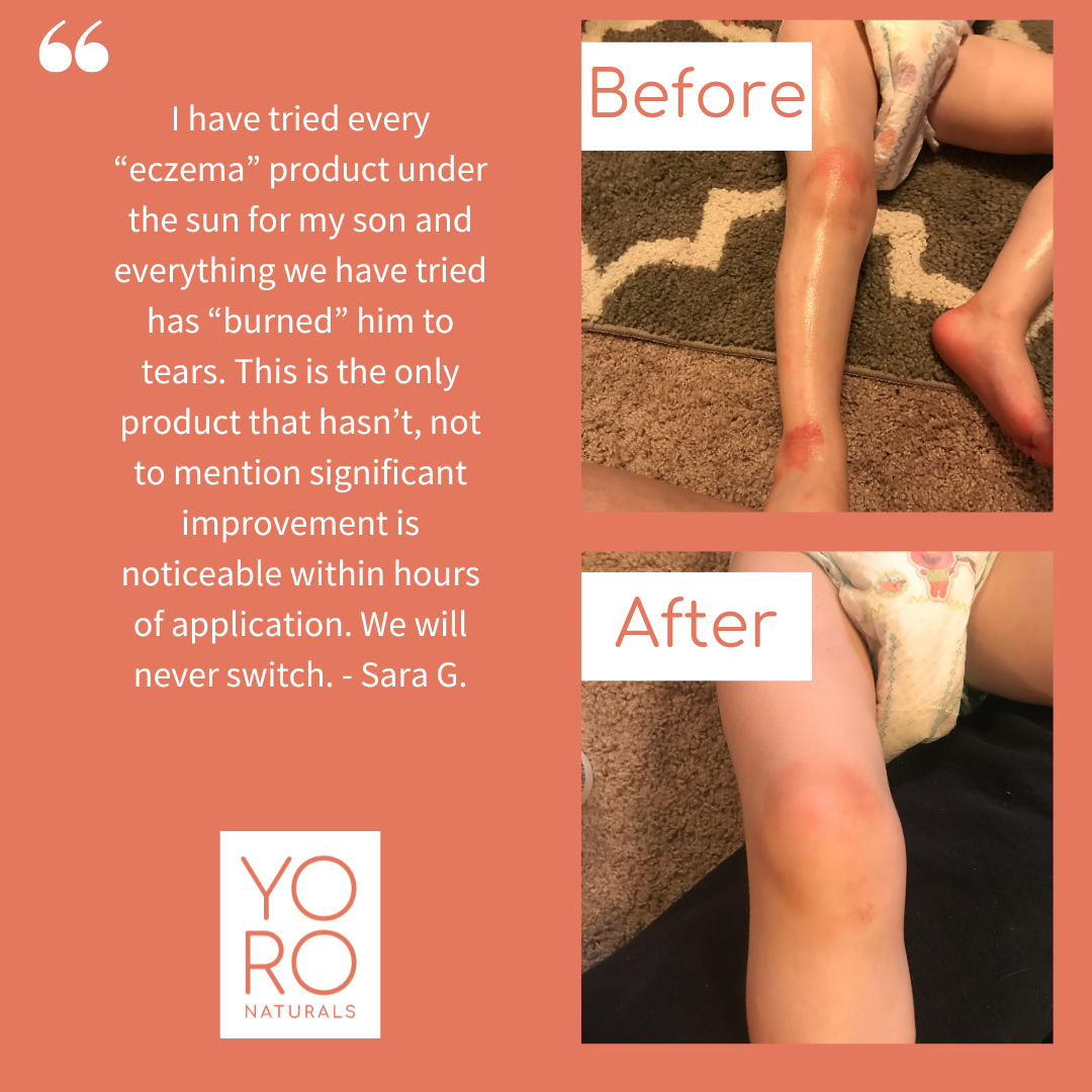 Organic Manuka Skin Soothing Cream by YoRo Naturals