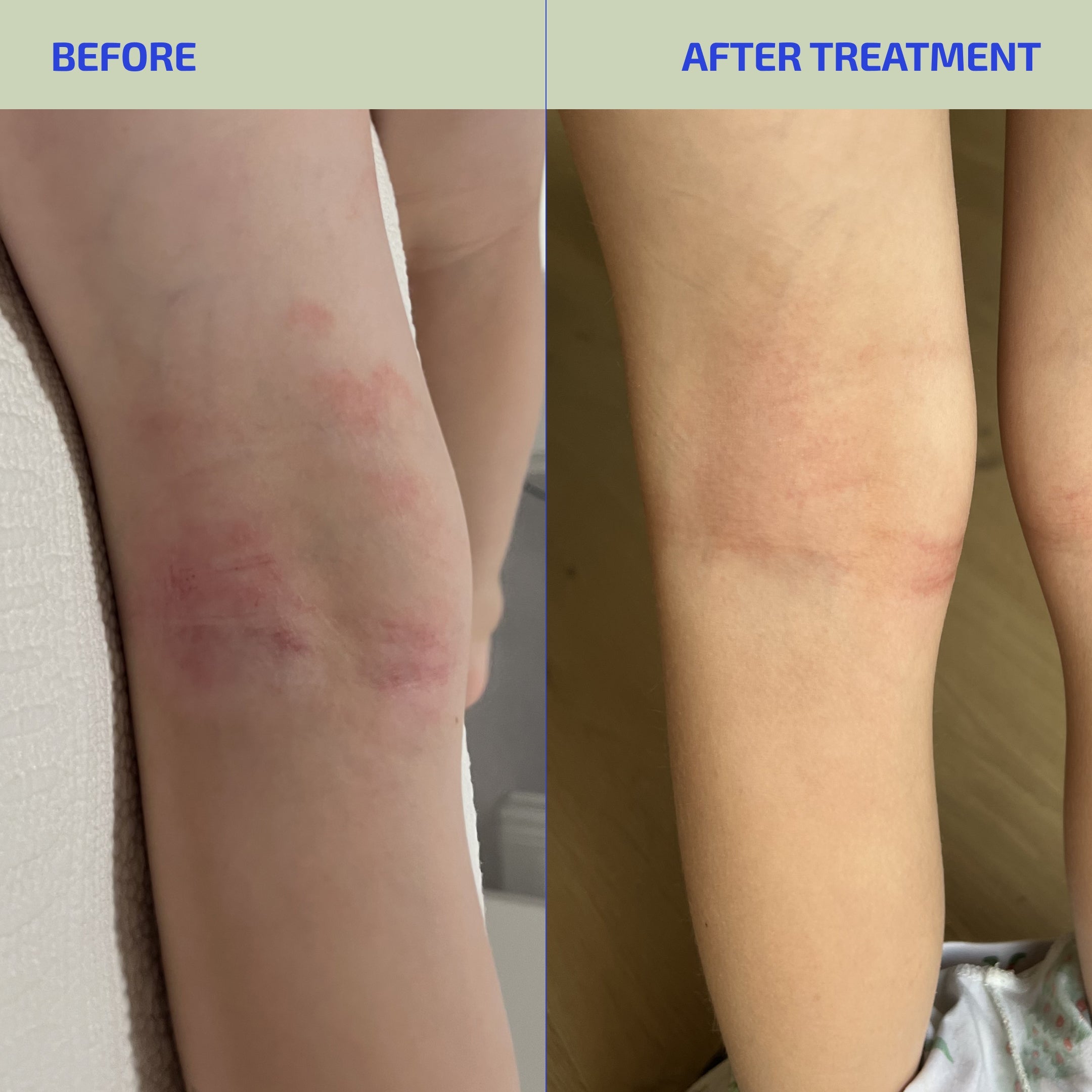 BIA Kids Eczema Relief Routine | Complete 30-Day Skin Barrier System (Age 4-12)