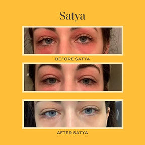 3 Photos of a woman's eyes with eczema and how it got better while using Satya.